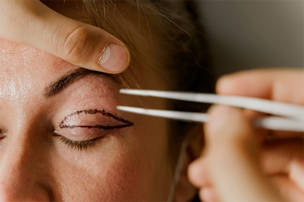 Blepharoplasty with surgery