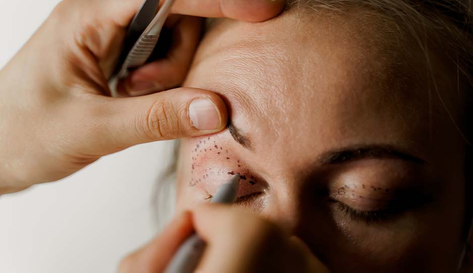 Upper eyelid blepharoplasty