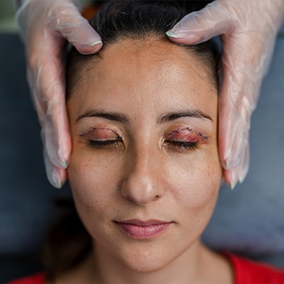 Complicaciones Blefaroplastia