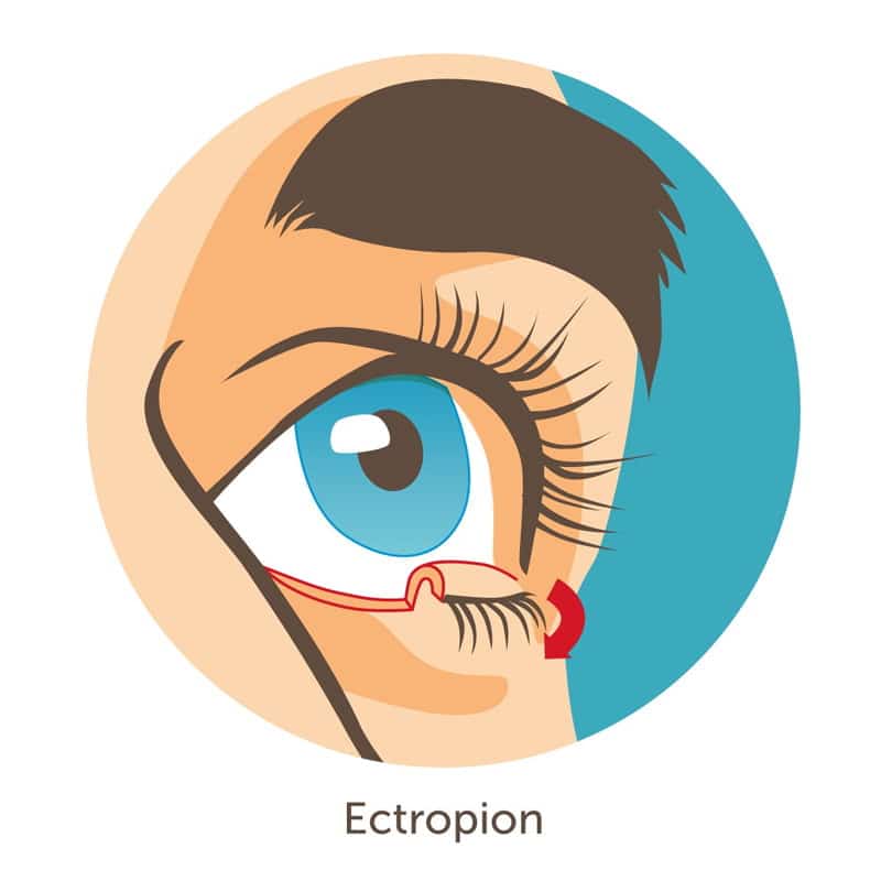 Ectropión
