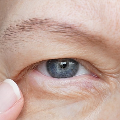 ptosis