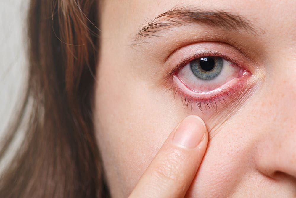 blefaroplastia