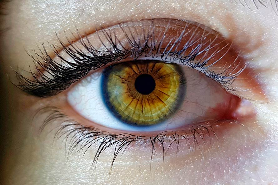 blefaroplastia-asimetria