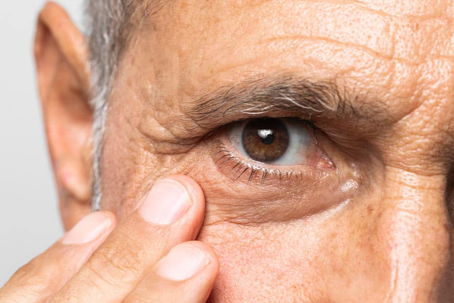 ptosis-palpebral-y-tratamiento