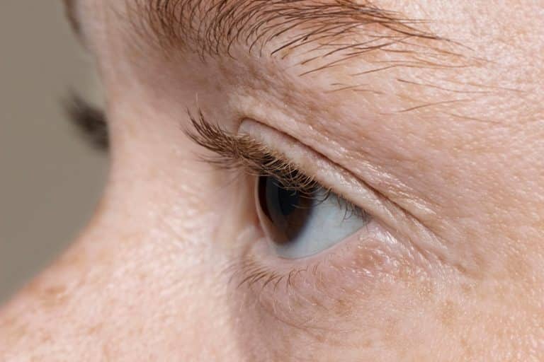 quitar-verrugas-de-los-ojos