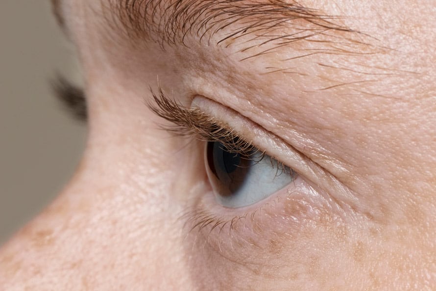 quitar-verrugas-de-los-ojos